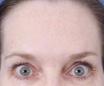 botulinum toxin After